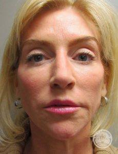 chin implant nashville