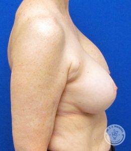 Patient Before Breast Implant Revision