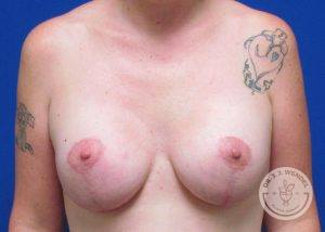 Patient After Breast Lift