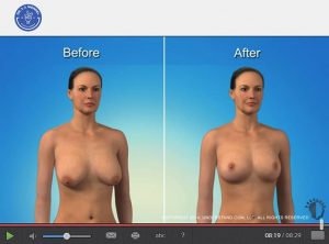 before and after computerized image of a woman receiving a breast lift