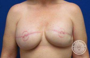 Patient Before and After Breast Reconstruction