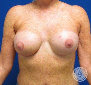Patient After Breast Reconstruction