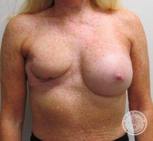 Patient Before Breast Reconstruction