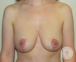 Patient After Breast Reduction