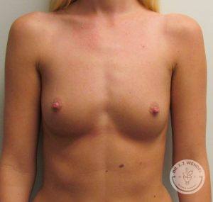 Patient Before Breast Augmentation