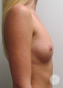 Patient Before Breast Augmentation