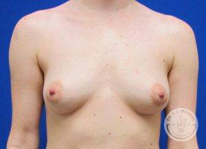 Patient Before Breast Augmentation