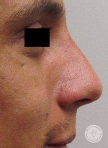 Nosejob Rhinoplasty After