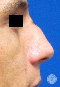 Nosejob Rhinoplasty Before