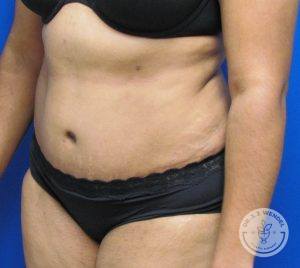 Tummy Tuck After