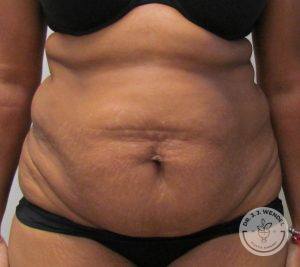 Tummy Tuck Before Front