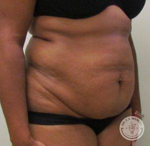 Tummy Tuck Oblique View 2 Before