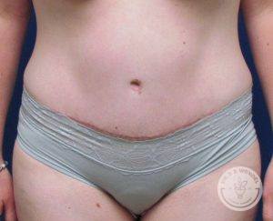 Tummy Tuck After