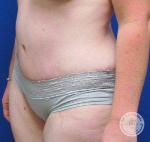 Tummy Tuck After