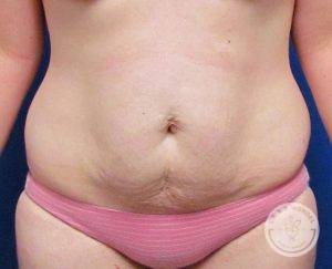 Tummy Tuck Before