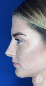 profile of a female face after receiving a non-surgical nose job procedure