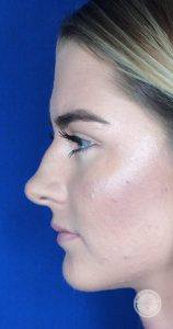 profile of a female face before receiving a non-surgical nose job procedure