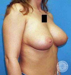 Saline breast implants Nashville
