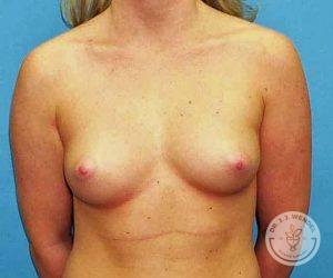 Woman Saline breast implants Nashville