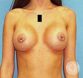Saline breast implants