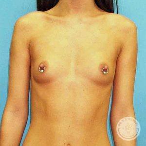 Saline breast implants