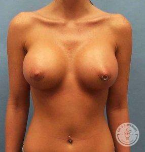 after saline breast implants Nashville