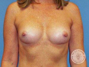 Woman after Silicone implants Nashville
