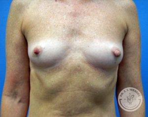 Woman before Silicone implants Nashville