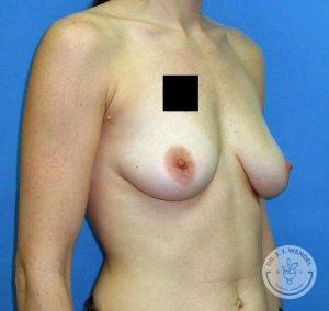 Before breast implants Nashville