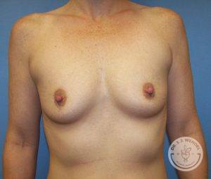 Silicone gel breast implants Nashville before and after