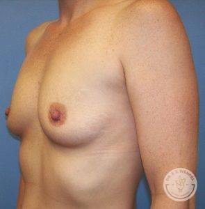 Silicone gel breast implants Nashville before and after