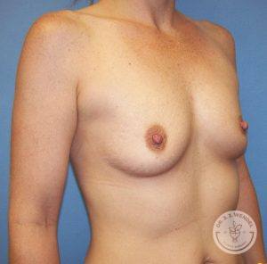 Silicone gel breast implants Nashville before and after