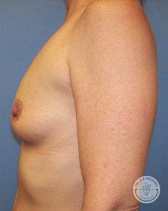 Silicone gel breast implants Nashville before and after