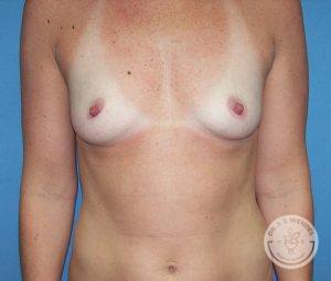 Breast implants Nashville TN