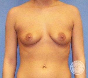 Breast Augmentation with Lift