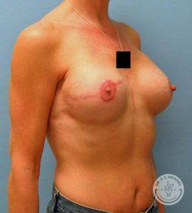 Tissue Expander Breast Reconstruction