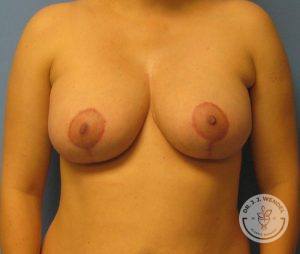 Woman after Breast Reduction Nashville