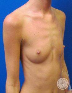 Silicone breast implants Nashville