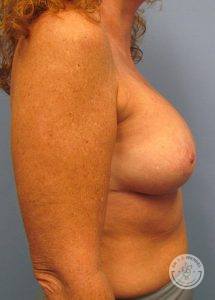 Breast Lift with Implants Nashville TN