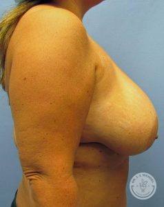 Woman before Breast Reduction Nashville