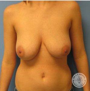 Woman before Breast Reduction Nashville