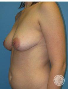 Woman after Breast Reduction Nashville