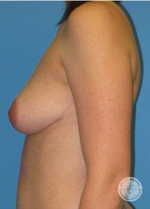 Woman after Breast Reduction Nashville