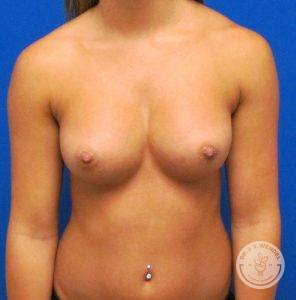 Silicone breast implants Nashville