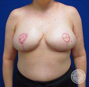Woman after Breast Reconstruction Nashville