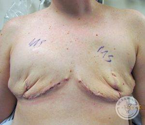 Woman before Breast Reconstruction Nashville