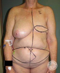 Woman before Breast Reconstruction DIEP Flap