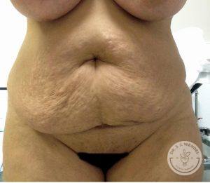 Woman Before After Tummy Tuck Nashville