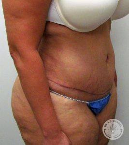 Woman Before After Tummy Tuck Nashville