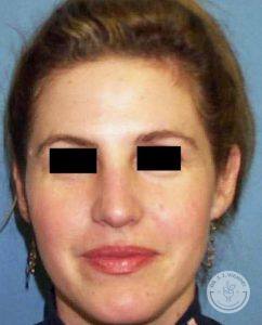 Woman after nose job - Nashville TN